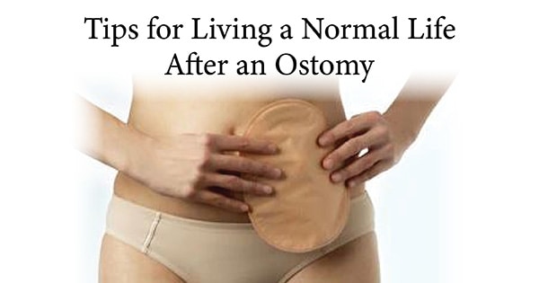 Tips for Living a Normal Life After an Ostomy