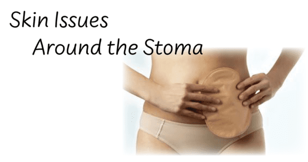 woman holding an ostomy pouch on her abdomen relating to skin issues around the stoma