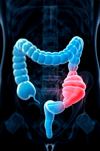 constipation in the intestines