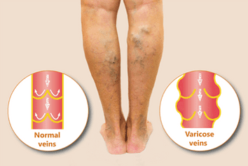 image of a person with varicose veins on their legs with what normal veins look like compared to what varicose veins look like