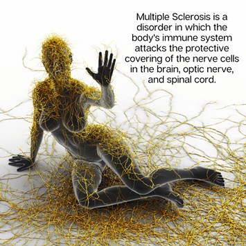 Multiple Sclerosis is a disorder in which the body's immune system attacks the protective covering of the nerve cells in the brain, optic nerve and spinal cord.