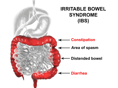 IBS diagram of constipation, area of spasm in the digestive tract, and where diarrhea begins